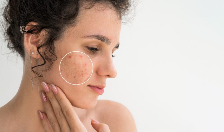 Portrait,Of,A,Young,Girl,With,Pimples,And,Acne,On