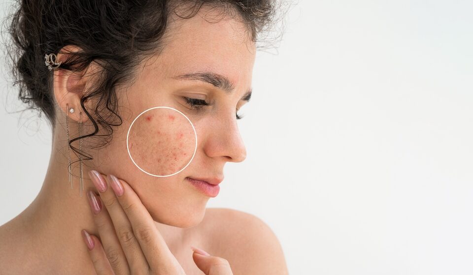 Portrait,Of,A,Young,Girl,With,Pimples,And,Acne,On