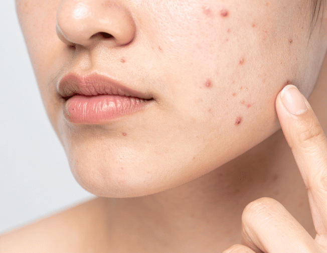 Acne & Pimples in Baner