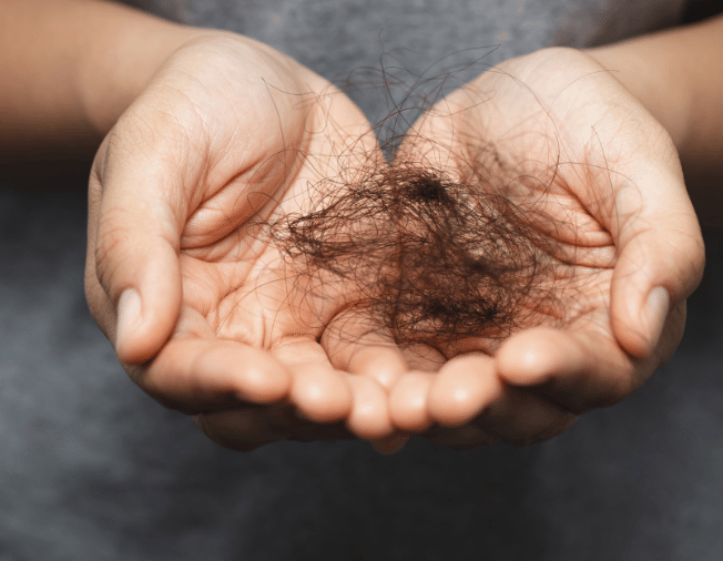 Hair Loss in Baner