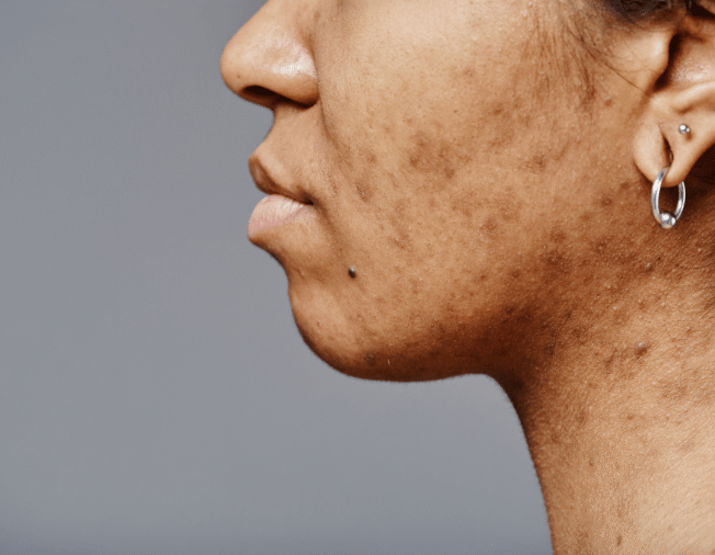 Pigmentation in Baner