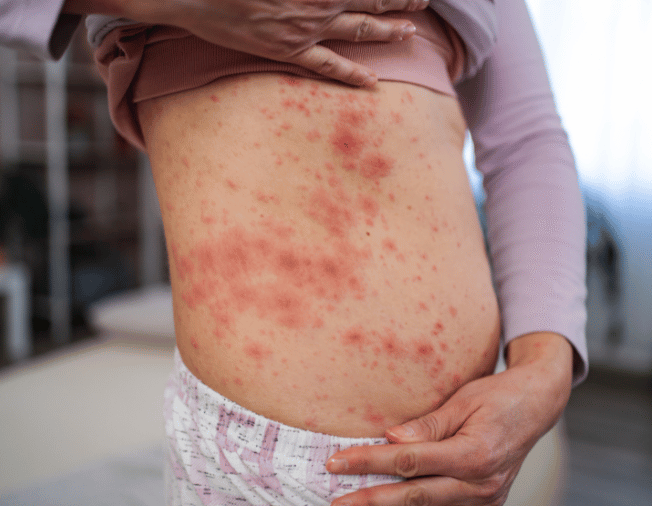 Skin Allergy in Baner